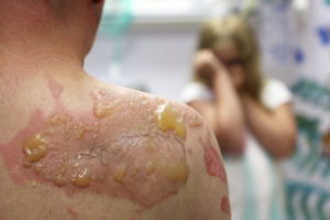 Burn Injury Lawyer, Orange County CA