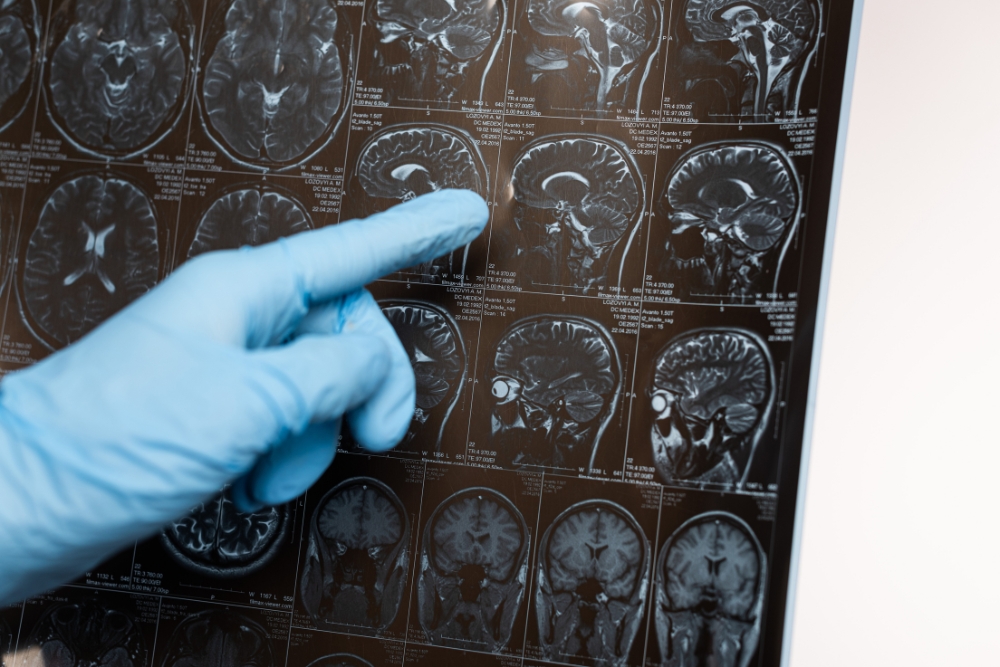 brain injury lawsuit faqs